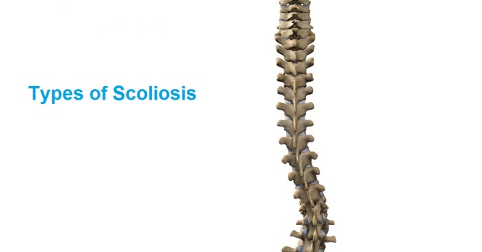 Scoliosis types by Dr. John Boyer Chiropractor